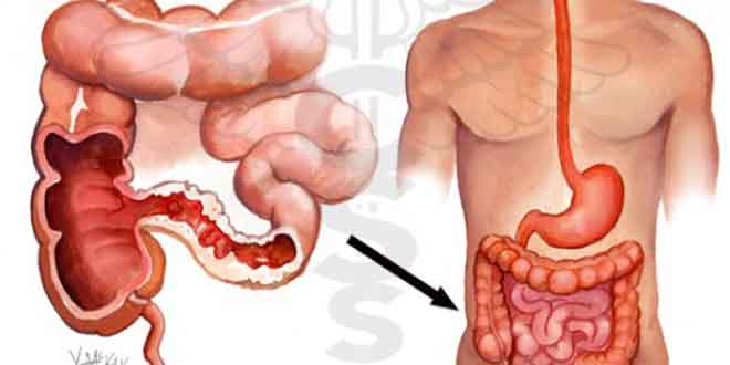 عکس از Orofacial Fistulae Associated with Crohn’s Disease