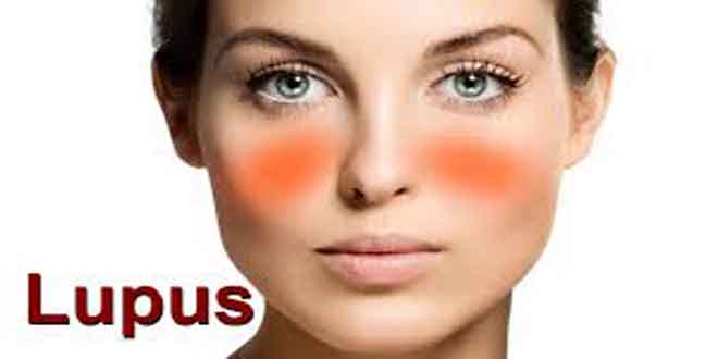 Photo of تائید Belimumab خودتزریقی برای لوپوس