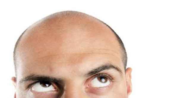کندن مو-درمان طاسي نتایج یک مطالعه جديد نشان مي‌دهد با کندن باقي‌مانده موهاي سر، مي‌توان به درمان طاسي به صورت جالبي کمک کرد. اين مطالعه که به سرپرستي پروفسور چنگ مينگ چوانگ از دانشگاه کاليفرنياي جنوبي به انجام رسيده