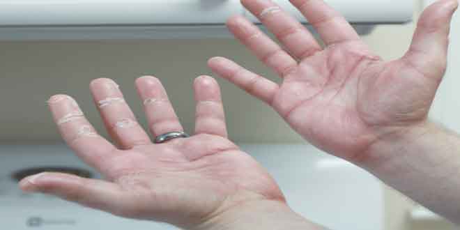 عکس از درمان سندرم دست -پاباآتورواستاتین