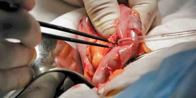 عکس از هیپوآلبومینمی وپیامدهای بدتر پس از جراحی IBD