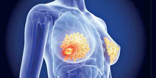 عکس از راهنمای بالینی سرطان پستان
