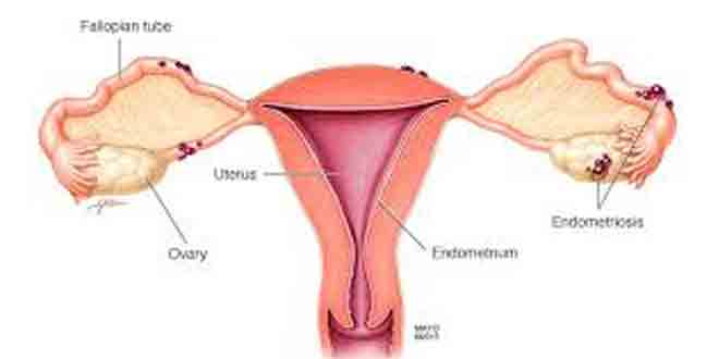 Photo of مهارکننده‌های PARP؛ طولانی‌تر کردن زمان بدون عود، نه لزوماً افزایش طول عمر