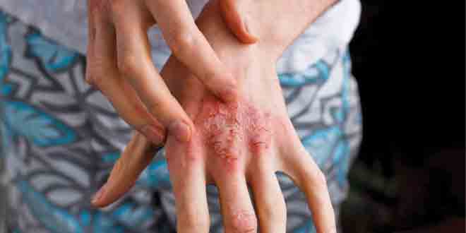 عکس از نقش مهار کننده را ههای التهابی در درمان اگزمای دست