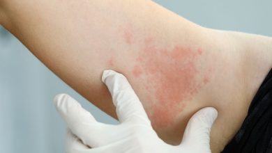 Photo of ارزشها و ترجیحات بیماران در درمان کهیر مزمن: مرور نظاممند شواهد جهانی