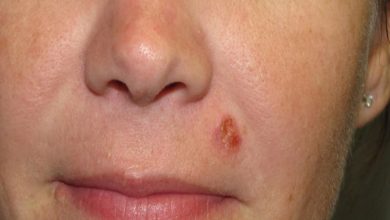 Photo of آیا شیمیدرمانی میتواند دوباره در درمان کارسینوم سلول سنگفرشی پوستی نقشآفرین شود؟