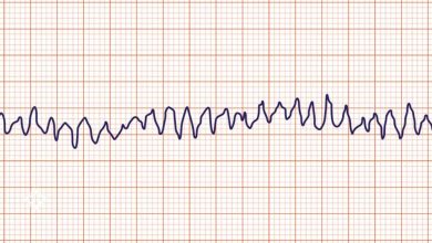 Photo of گزارش بالینی: یک الگوی متمایز ECG با آریتمیهای بدخیم همزمان