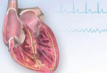 Photo of یک انقباض دهلیزی زودرس «بدخیم»: چگونه یک PAC ساده می‌تواند بلوک کامل قلبی پاروکسیسمال را فعال کند؟