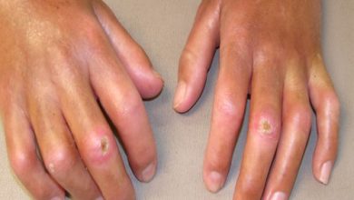 Photo of درمان ایسکمی انگشتی مقاوم با سم بوتولینوم در اسکلروز سیستمیک