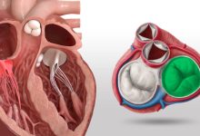 Photo of درمان نارسایی دریچه تریکوسپید؛ بررسی جامع روش‌های دارویی، جراحی و مداخلات کم‌تهاجمی