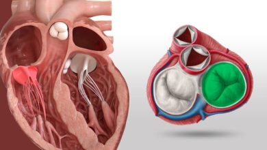 Photo of درمان نارسایی دریچه تریکوسپید؛ بررسی جامع روش‌های دارویی، جراحی و مداخلات کم‌تهاجمی