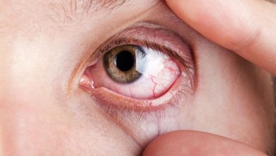 Photo of عوارض سمی چشمی در طول درمان با میروتوکسیماب سوراوتانسین (Mirvetuximab Soravtansine)