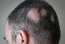 Photo of آلوپسی منتشر پوست سر و ابروها؛ تظاهر گمراه‌کننده سیفلیس ثانویه