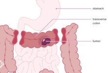 Photo of تشخیص دیرهنگام نشت آناستوموز و افزایش خطر مرگ پس از جراحی برداشت کولون