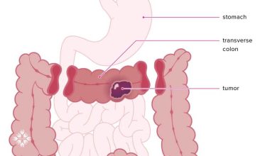 Photo of تشخیص دیرهنگام نشت آناستوموز و افزایش خطر مرگ پس از جراحی برداشت کولون
