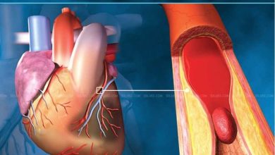 Photo of انفارکتوس میوکارد خلفیِ نادیده‌گرفته‌شده؛ از تفسیر اشتباه ECG تا پارگی دیواره آزاد بطن چپ