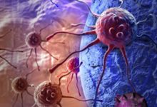 Photo of درمان کانونی نجات‌بخش در برابر پروستاتکتومی رادیکال نجات‌بخش در سرطان پروستات عودکننده موضعی پس از رادیوتراپی