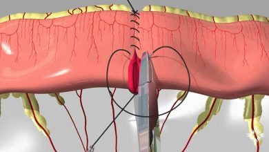 Photo of بازاندیشی در «شکست در نجات» پس از نشت آناستوموز: اهمیت تشخیص زودهنگام و راهبردهای نوین پیشگیری