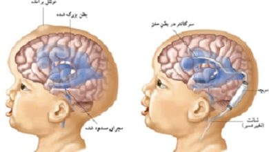 Photo of عصر جدید هیدروسفالی ایدیوپاتیک با فشار طبیعی (iNPH): از تردید تا شواهد قطعی