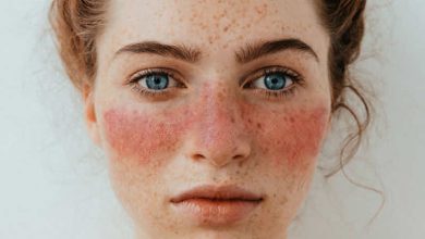 Photo of کاهش فعالیت بیماری لوپوس با آنیفرولوماب؛ SIGLEC-1 به‌عنوان نشانگر زیستی نویدبخش برای پایش پاسخ درمانی