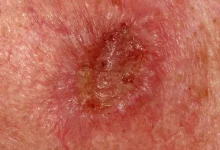 Photo of ارزیابی غدد لنفاوی در سرطان سلول سنگفرشی پوست؛ سونوگرافی بهتر است یا سی‌تی اسکن؟