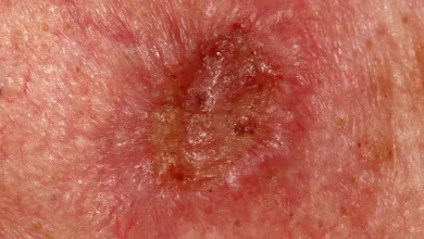 Photo of ارزیابی غدد لنفاوی در سرطان سلول سنگفرشی پوست؛ سونوگرافی بهتر است یا سی‌تی اسکن؟