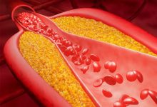 Photo of ویرایش پایه‌ی ژن PCSK9 با VERVE-102؛ گامی نوین در درمان پایدار هایپرکلسترولمی
