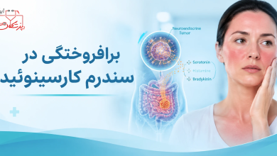 Photo of برافروختگی در سندرم کارسینوئید؛ از پاتوفیزیولوژی تا مدیریت بالینی فلاشینگ مقاوم